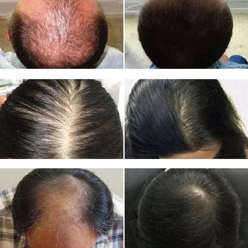 biotina crescimento dos cabelos,soro,tratamento do coura cabeludo,para barba cuidado com o sprey